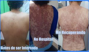 Vaquinha Online - AJUDA para Tratamento dos efeitos da Síndrome de Steven Johnson e Dor Miofascial