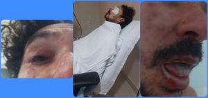 Saúde e Emergências - AJUDA para Tratamento dos efeitos da Síndrome de Steven Johnson e Dor Miofascial