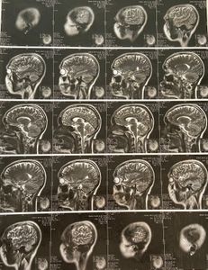 Avaré/SP - Ajude Bianca Helen Tiburcio Na Luta Contra o Tumor Cerebral