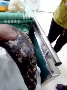 Vaquinha Online - Cadeira de rodas motorizada, trasporte para fazer  hemodiálise e rampa na casa 