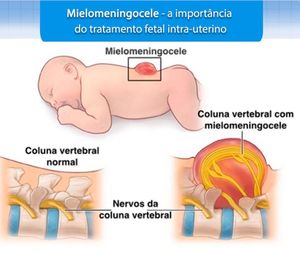 Vaquinha Online - Lis Vitória - Cirugia para uma vida melhor! 