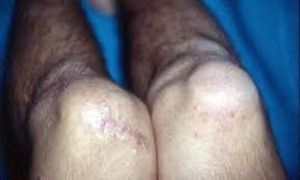 Vaquinha Online - Fazer cirurgia e tratamento de lesão ligamentar de joelho 