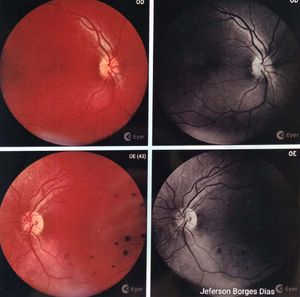 Cirurgia para não perder a visão  imagem 9
