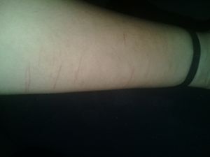 Vaquinha Online - Ajuda para cobrir cicatrizes suicidas 