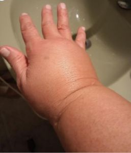 Vaquinha Online - SEQÜELA DE CÂNCER