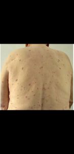 Crowdfunding - Tratamento de Leucemia 