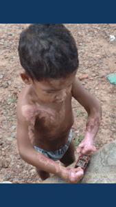 Ajude sobreviventes de queimaduras imagem 7