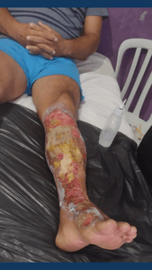 Ajude sobreviventes de queimaduras imagem 9