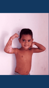 Caxias/MA - Ajude sobreviventes de queimaduras