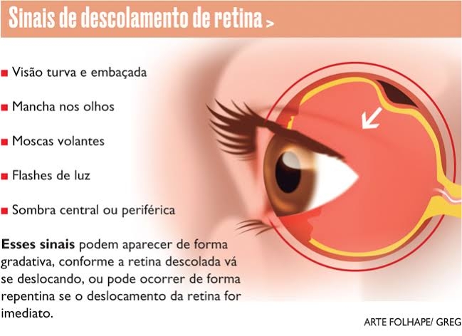 Deslocamento de Retina ( preciso de cirurgia)