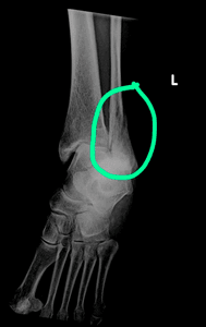 Vaquinha Online - Ajude Luciene Schalm | Pós-cirurgia e Adaptação