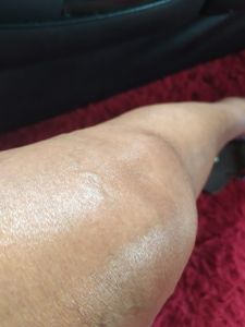 Vaquinha Online - Arrecadação para cirurgia no joelho esquerdo 