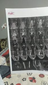 Saúde e Emergências - Arrecadação para cirurgia no joelho esquerdo 