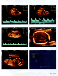 Cirurgia Intrauterina – MIELOMELINGOCELE SACRAL imagem 7