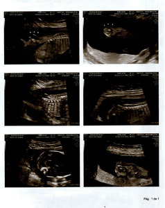 Cirurgia Intrauterina – MIELOMELINGOCELE SACRAL imagem 8