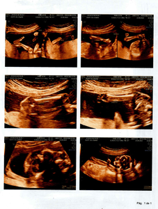 Cirurgia Intrauterina – MIELOMELINGOCELE SACRAL imagem 6