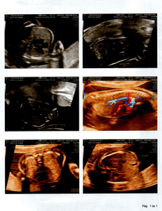 Feira de Santana/BA - Cirurgia Intrauterina – MIELOMELINGOCELE SACRAL