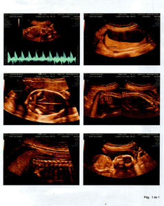 Cirurgia Intrauterina – MIELOMELINGOCELE SACRAL - Cirurgia Intrauterina – MIELOMELINGOCELE SACRAL