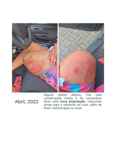 Prótese para o Victor imagem 6