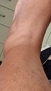 Vaquinha Online - Ajuda doença autoimune Espondilite 