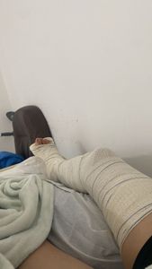 ONGs - Cirurgia para colocação do fixador ilazarov 10 pinos 