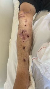 Vaquinha Online - Cirurgia para colocação do fixador ilazarov 10 pinos 