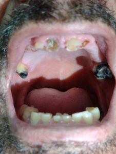 Vaquinha Online - Comi meus próprios dentes 