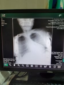 Vaquinha Online - Ajude com cirurgia de escóliose de Mercy 