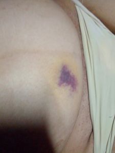 Vaquinha Online - AJUDEM INGRID, CIRUGIA DE 7 HERNIAS MAIS ABDOMINO