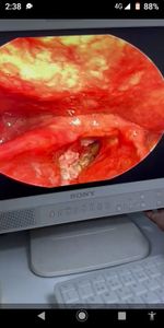 Ajuda Manoel Mauricio Lima Para Cirurgia Laringectomia imagem 7