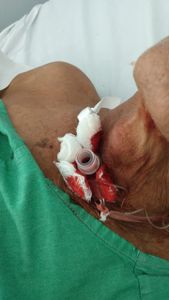 Itabaiana/SE - Ajuda Manoel Mauricio Lima Para Cirurgia Laringectomia