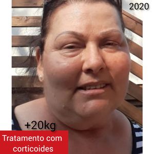 Ajude no tratamento da Ana - Doença rara, grave e crônica cujo o tratamento leva a diversos efeitos colaterais - Ajude no tratamento da Ana