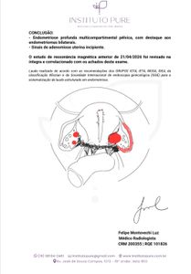 Ajude me a vencer a endometriose 
