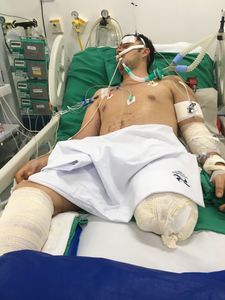 Crowdfunding - Prótese do Victor: Vamos juntos, um passo de cada vez!
