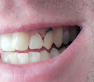 Crowdfunding - Ajuda para pagar tratamento dentário