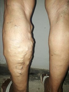 Vaquinha Online - Ajuda para custear dois procedimentos cirúrgicos nas varizes e nos olhos da minha mãe 