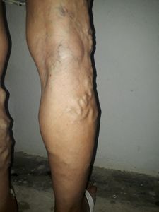 Vaquinha - Ajuda para custear dois procedimentos cirúrgicos nas varizes e nos olhos da minha mãe 