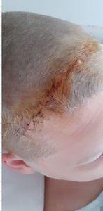 Vaquinha Online - Gabriel quer viver e precisa de ajuda para combater o câncer!