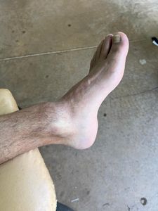 Thiago Bomfim, autônomo sem trabalhar por 6 meses fratura de tornozelo. imagem 7