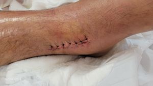 THIAGO BOMFIM, autônomo tornozelo quebrado sem condições para trabalhar no momento por no mínimo 6 meses. - Thiago Bomfim, autônomo sem trabalhar por 6 meses fratura de tornozelo.