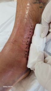 Brasília/DF - Thiago Bomfim, autônomo sem trabalhar por 6 meses fratura de tornozelo.