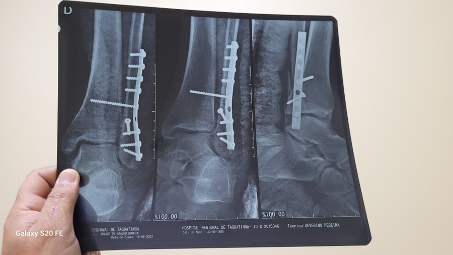 Saúde e Emergências - Thiago Bomfim, autônomo sem trabalhar por 6 meses fratura de tornozelo.