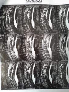 Eventos do Bem - Cirurgia da coluna