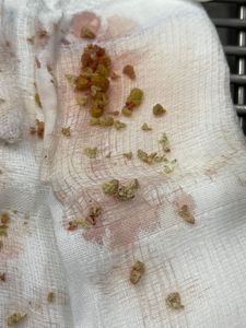 Cirurgia do Bruce  - Cirurgia do Bruce 