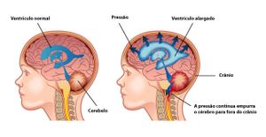Julia quer viver e precisa da sua ajuda para combater a Síndrome de Arnold Chiari, Siringomielia e Escoliose!
