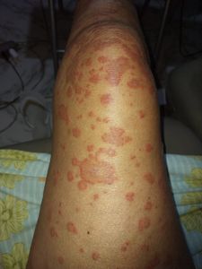 Vaquinha Online - Ajuda com tratamento de Linfoma Atll