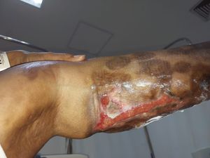 Duque de Caxias/RJ - Ajuda com tratamento de Linfoma Atll