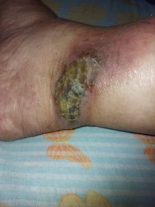 Saúde e Emergências - Ajuda com tratamento de Linfoma Atll