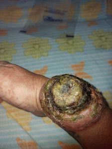 Ajuda com tratamento de Linfoma Atll