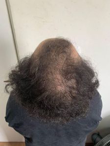 Vaquinha Online - TRANSPLANTE CAPILAR DA JUNIA ALMEIDA